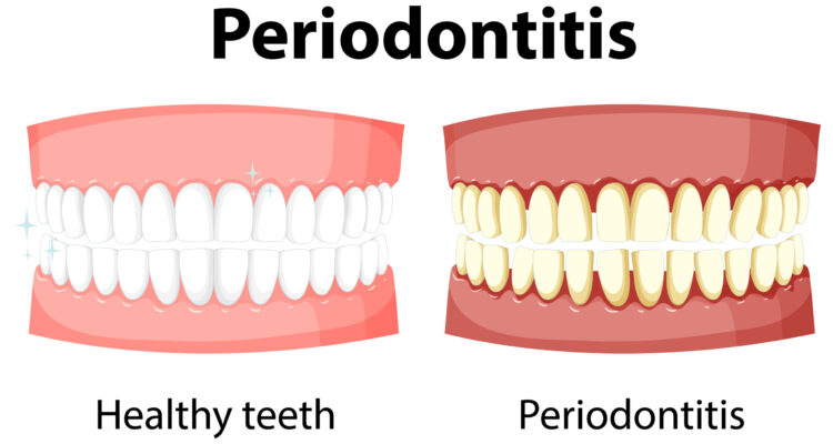 Infographic of human in periodontitis illustration